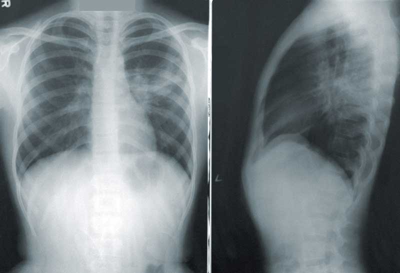 X-rays of human lungs. CT & MA Radon Testing.